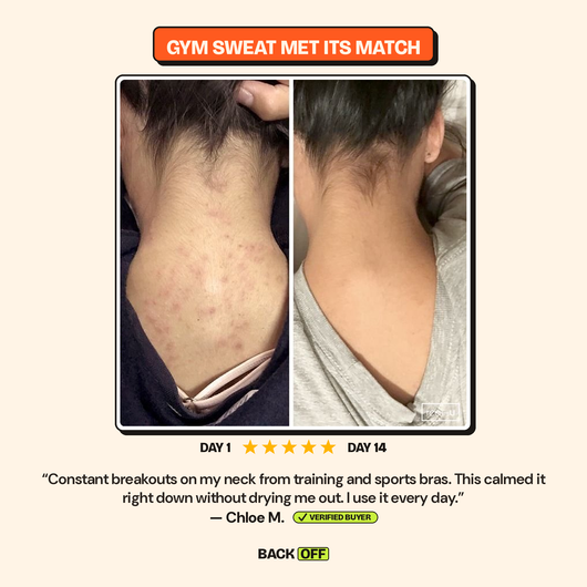 The Back Off Bar™ — Natural Soap for Back, Chest & Body Acne